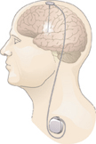 An illustration of DBS for Parkinson's disease. Fine wires are implanted within brain regions involved in motor control, and stimulation is controlled by a pacemaker-like device under the skin.
